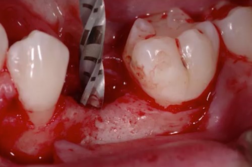 Performing the implant placement