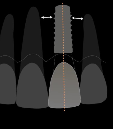 Finding the ideal implant position