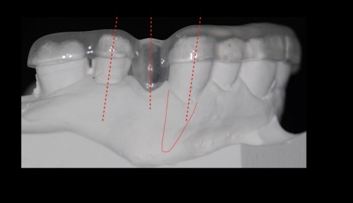 Conventional surgical templates